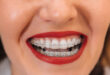 Orthodontics Aligning Smiles to Perfection