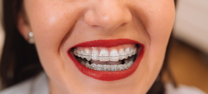 Orthodontics Aligning Smiles to Perfection